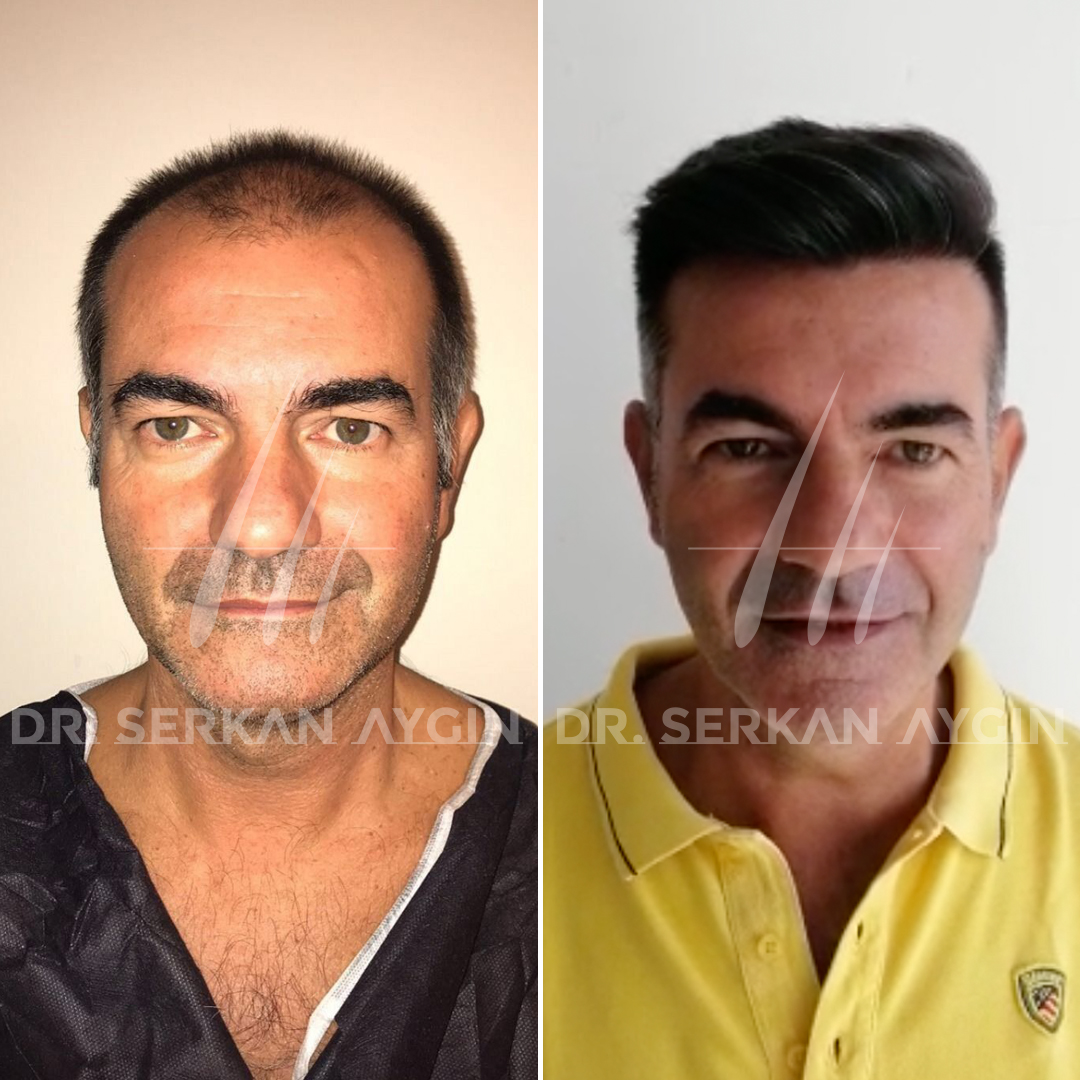 Natürliche Haartransplantation Vorher-Nachher-Ergebnisse der Dr. Serkan Aygin Clinic. Foto: https://www.drserkanaygin.com/de/