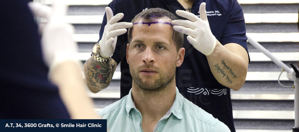 Die kostenlose Beratung vor der Behandlung zeigt auf, wie viele Grafts (Haarwurzeln) benötigt werden. Foto: Smile Hair Clinic